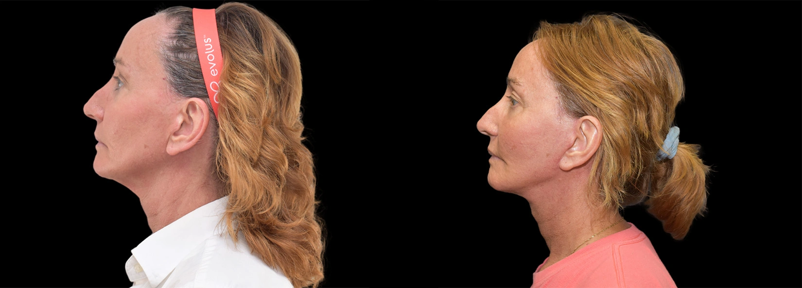 Real Patient Results of Dr. Wilson of Lake Norman Plastic Surgery