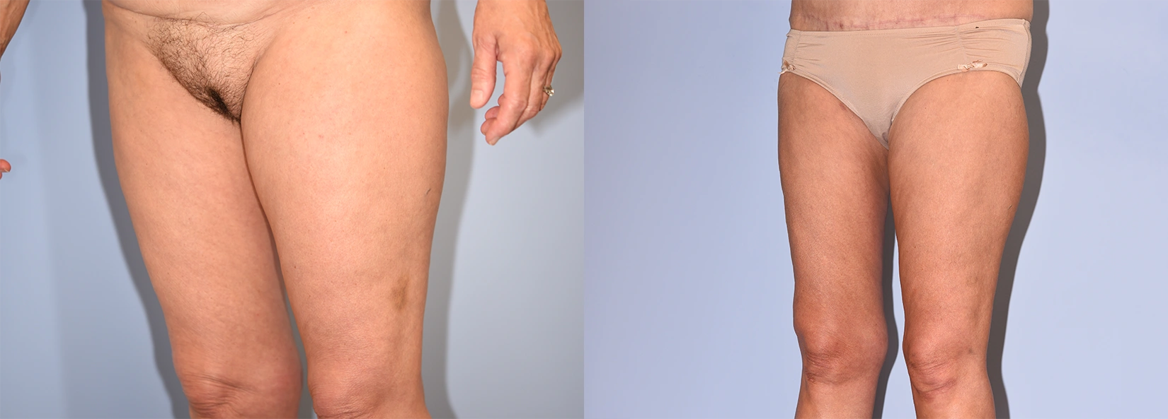 Real Patient Results of Dr. Wilson of Lake Norman Plastic Surgery