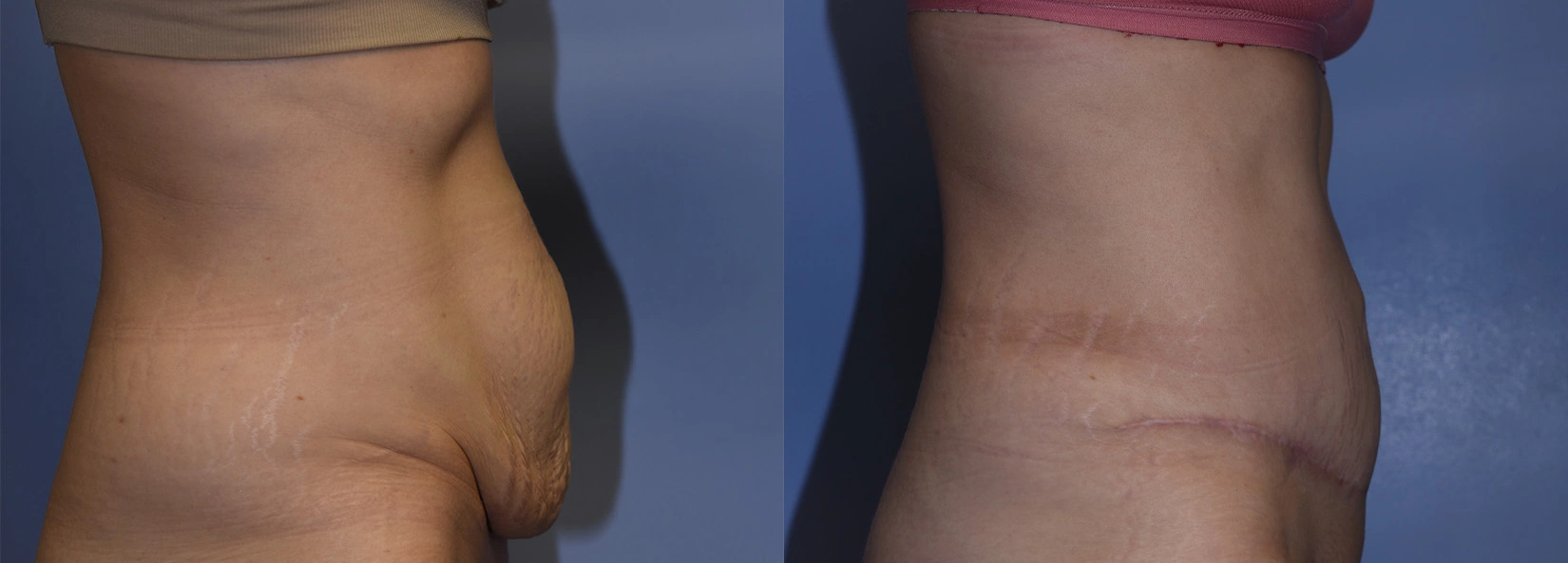 Real Patient Results of Dr. Wilson of Lake Norman Plastic Surgery