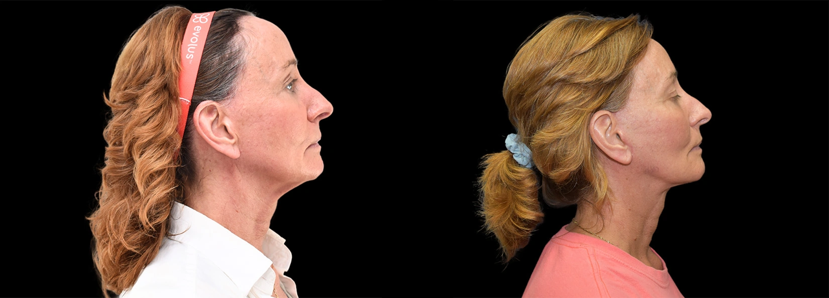 Real Patient Results of Dr. Wilson of Lake Norman Plastic Surgery