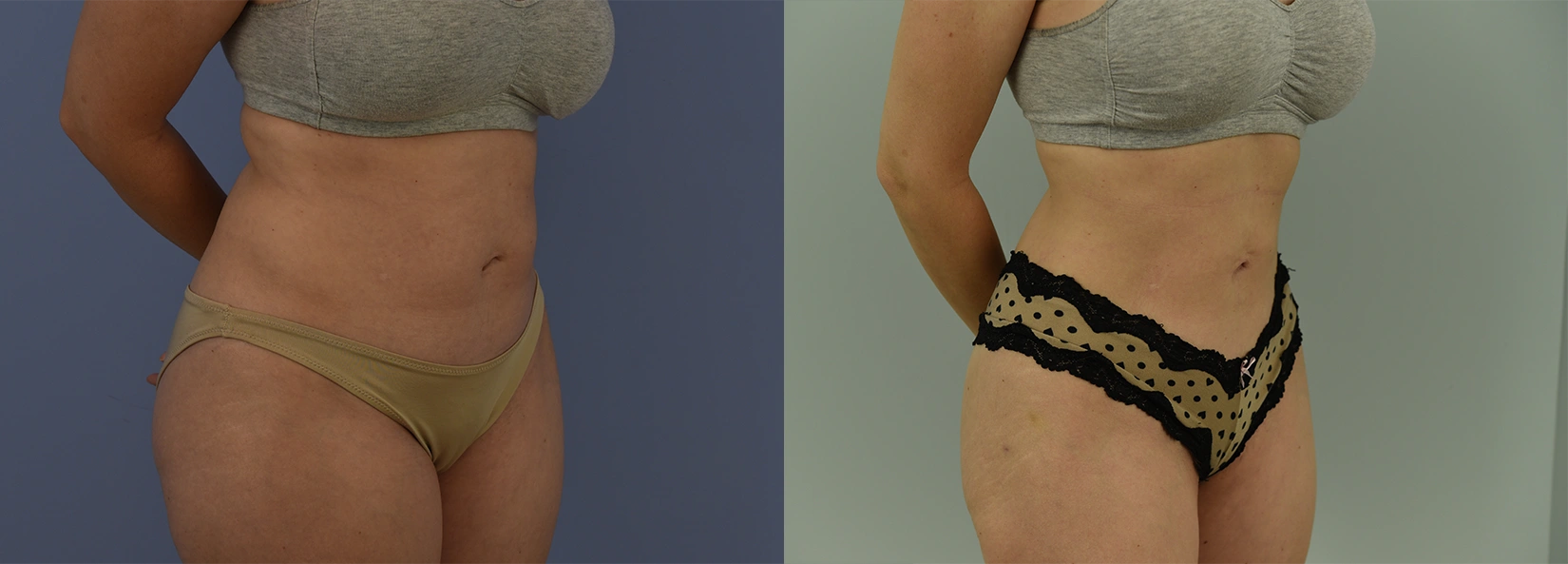 Real Patient Results of Dr. Wilson of Lake Norman Plastic Surgery