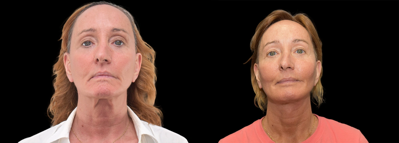 Real Patient Results of Dr. Wilson of Lake Norman Plastic Surgery