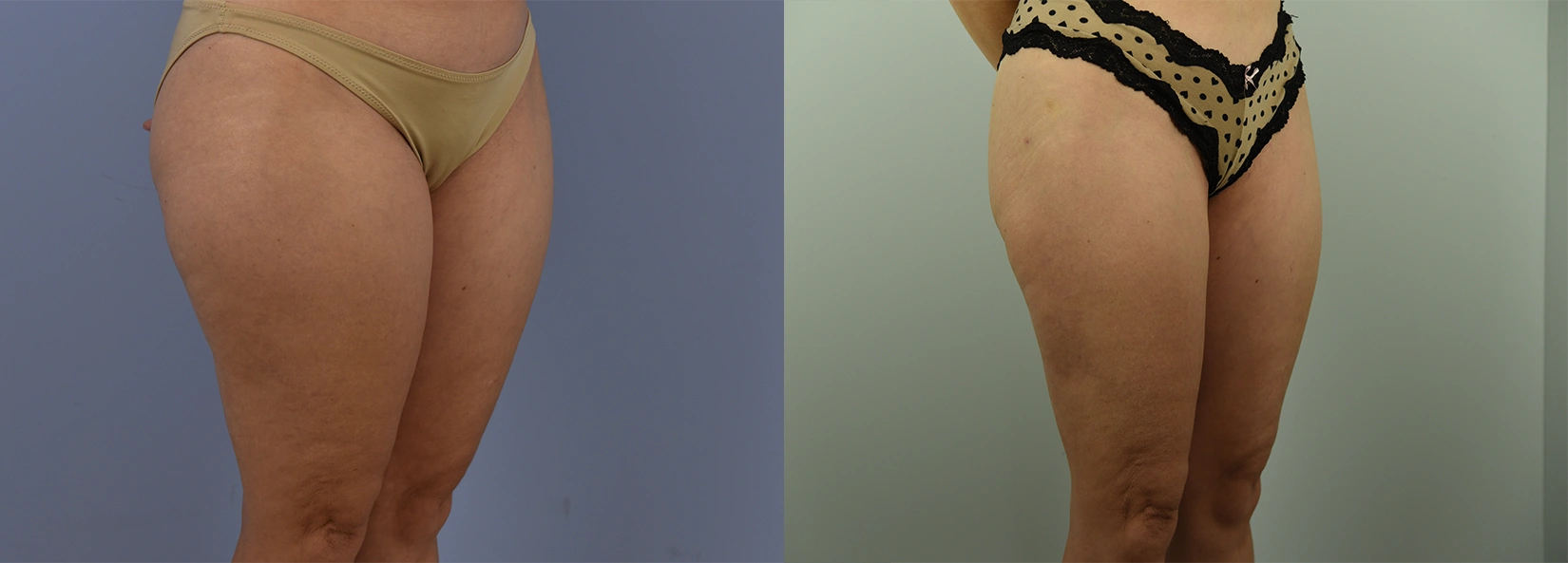 Real Patient Results of Dr. Wilson of Lake Norman Plastic Surgery