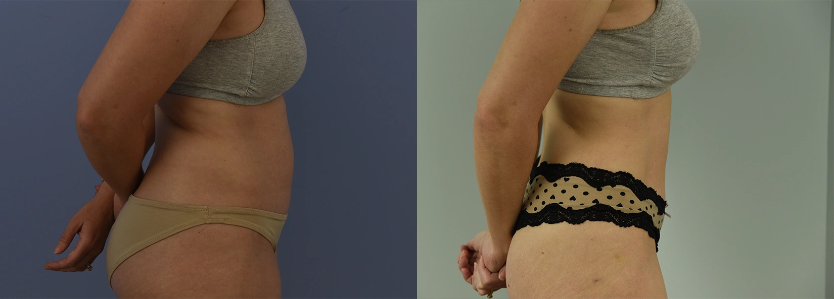 Real Patient Results of Dr. Wilson of Lake Norman Plastic Surgery