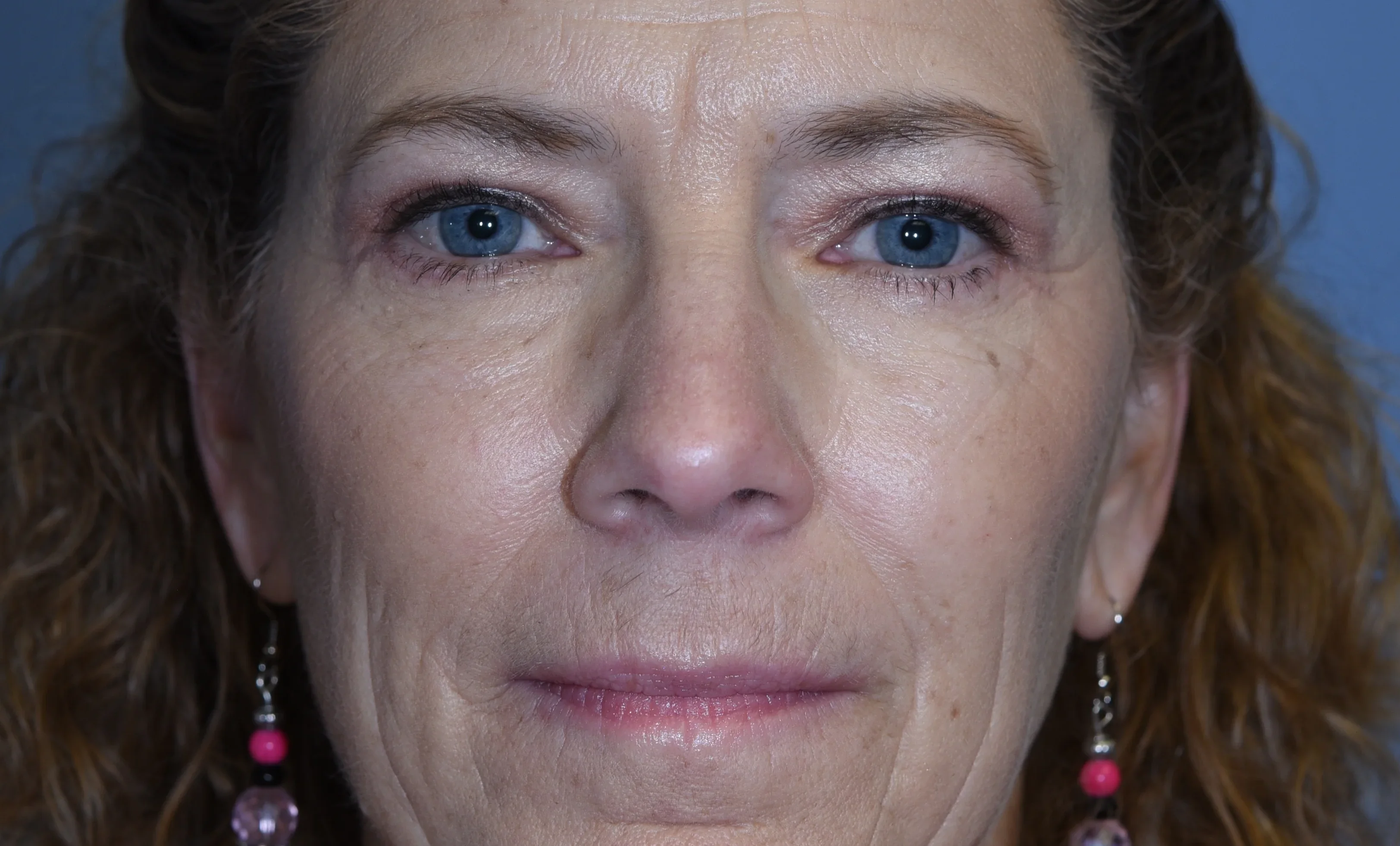 eyelid-surgery-01of10