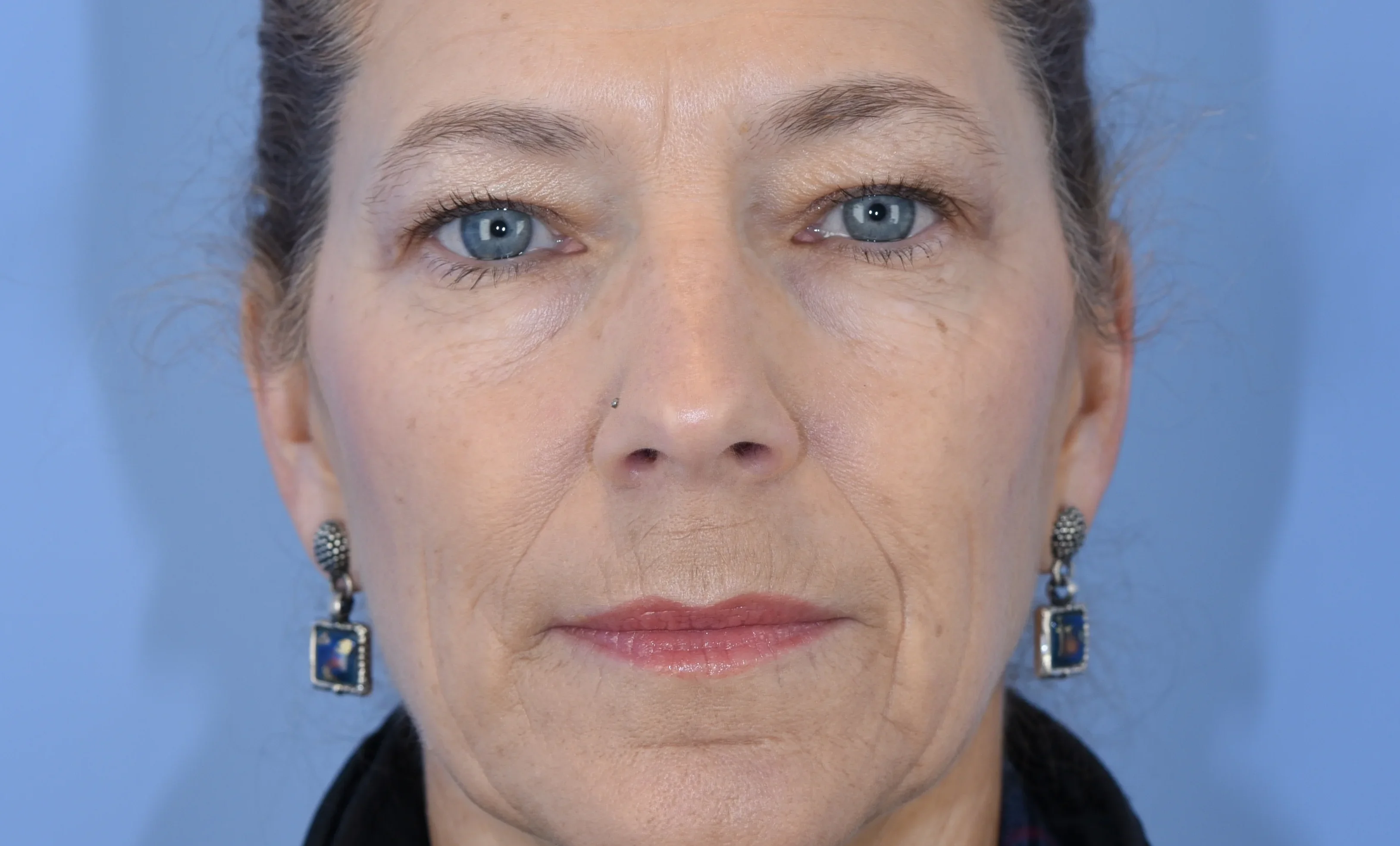 eyelid-surgery-02of10