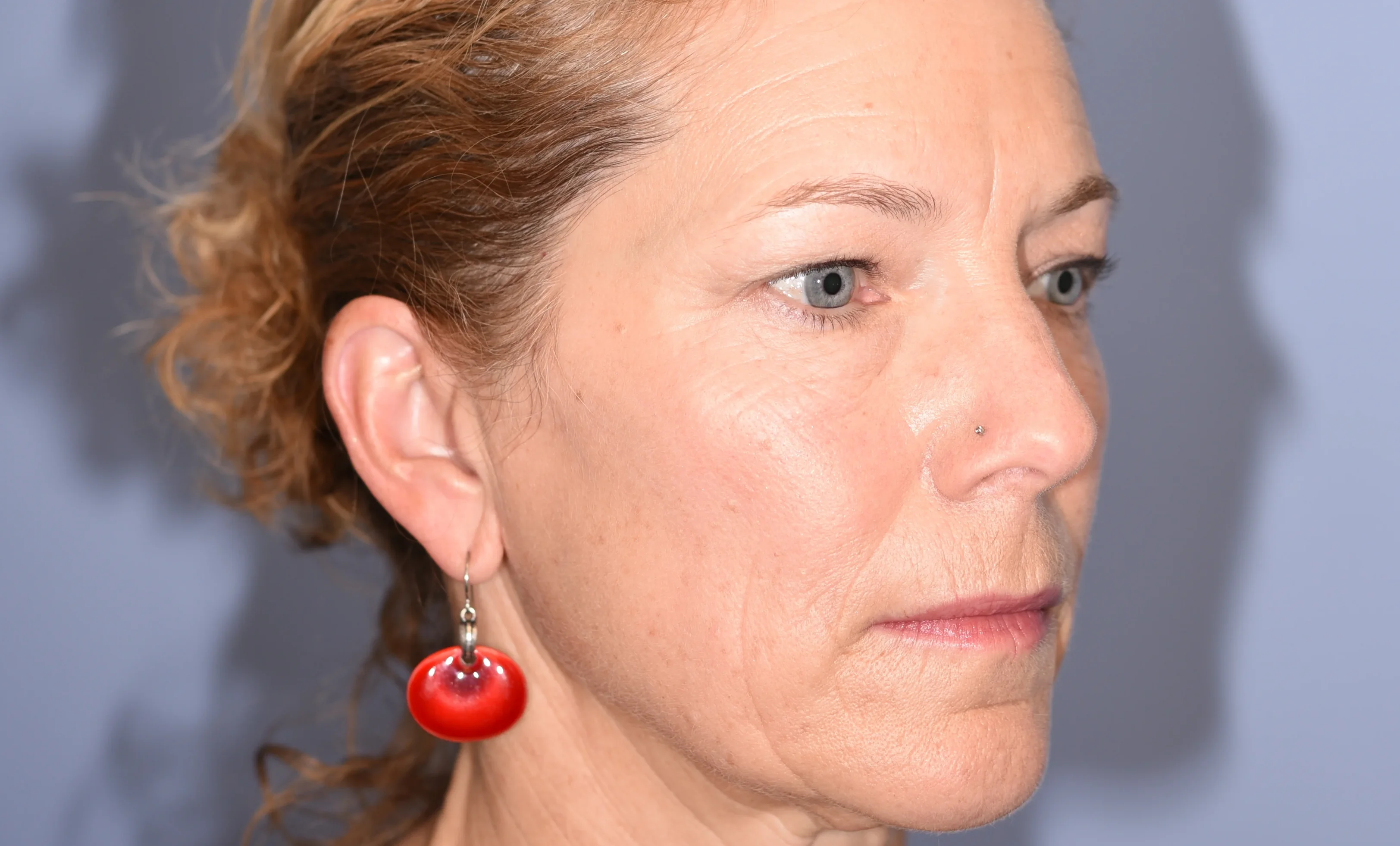 eyelid-surgery-03of10