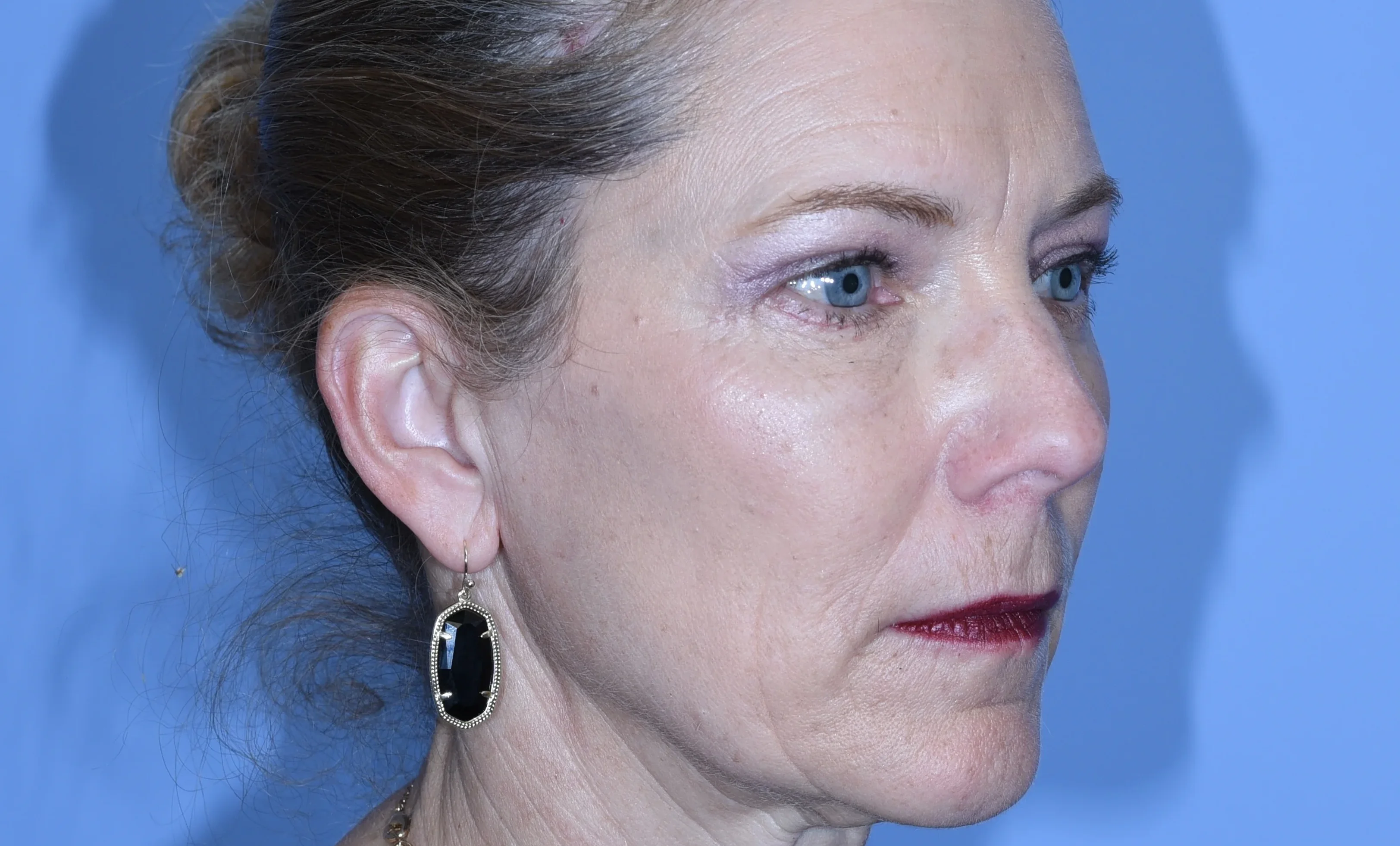 eyelid-surgery-04of10