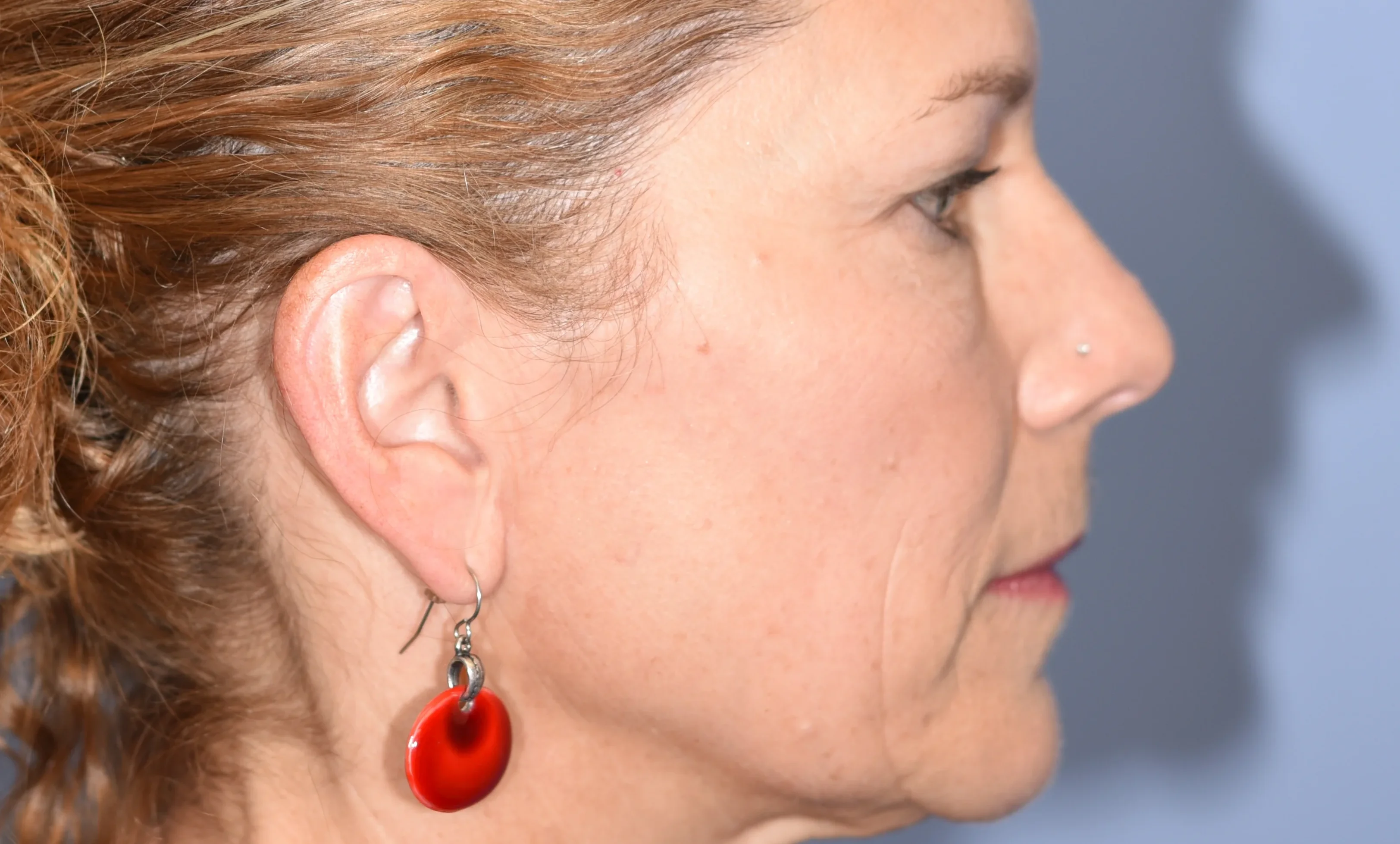 eyelid-surgery-05of10