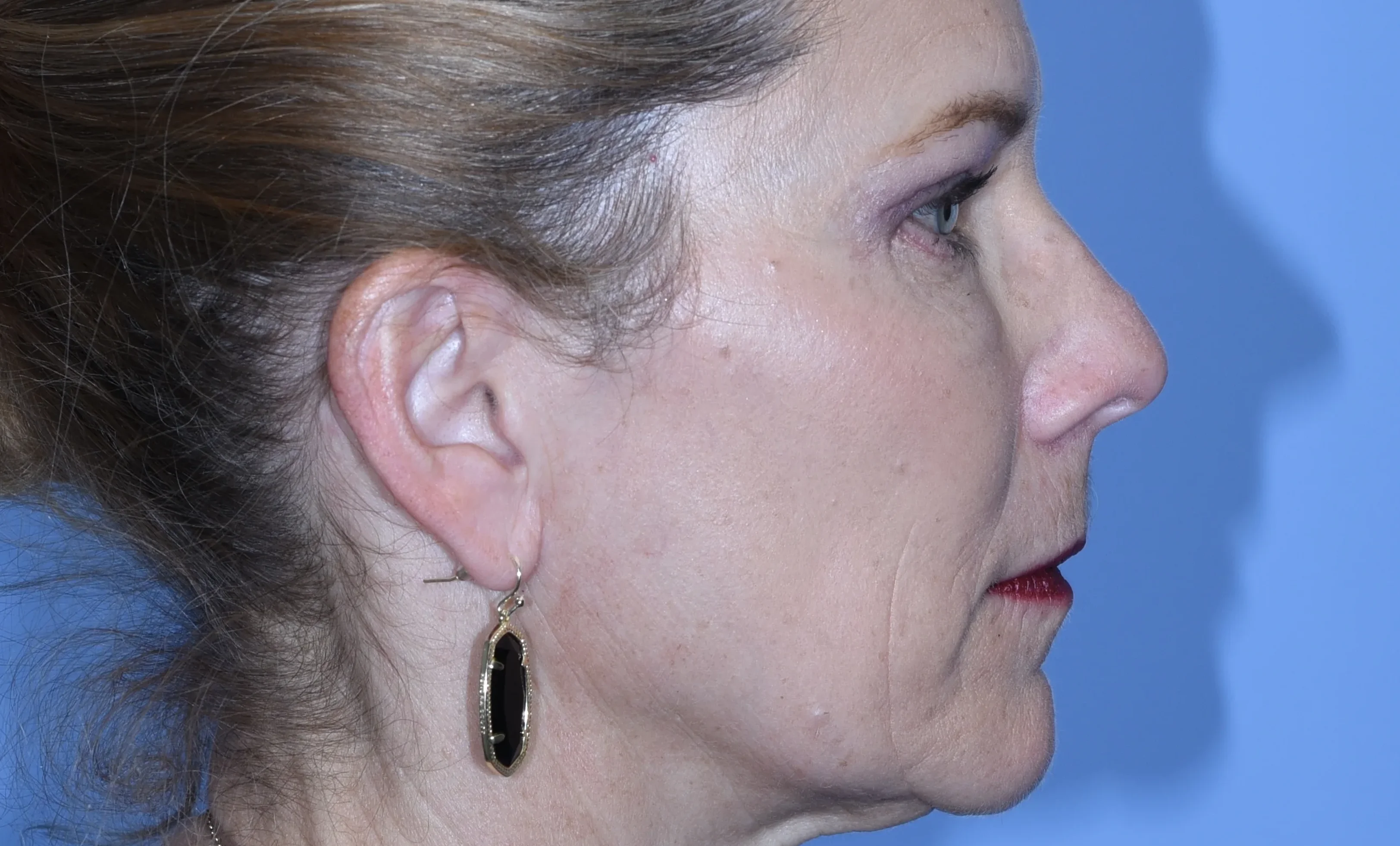 eyelid-surgery-06of10