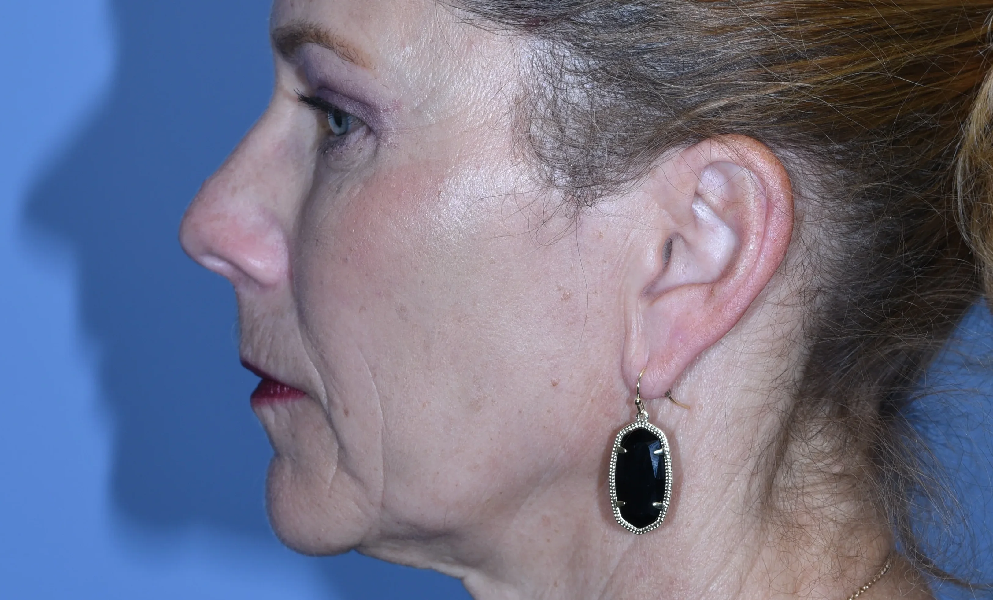 eyelid-surgery-08of10