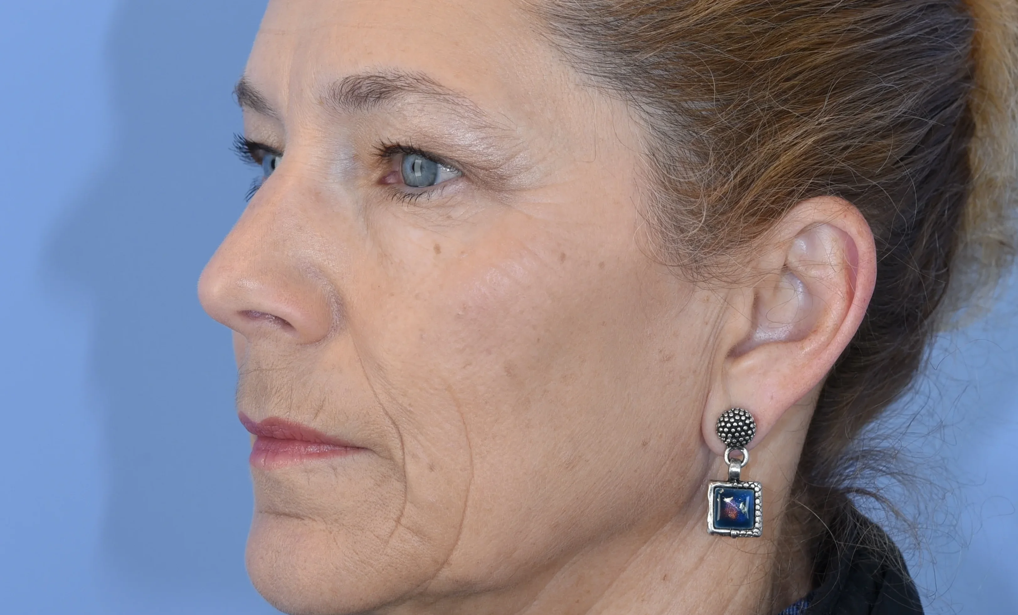 eyelid-surgery-09of10