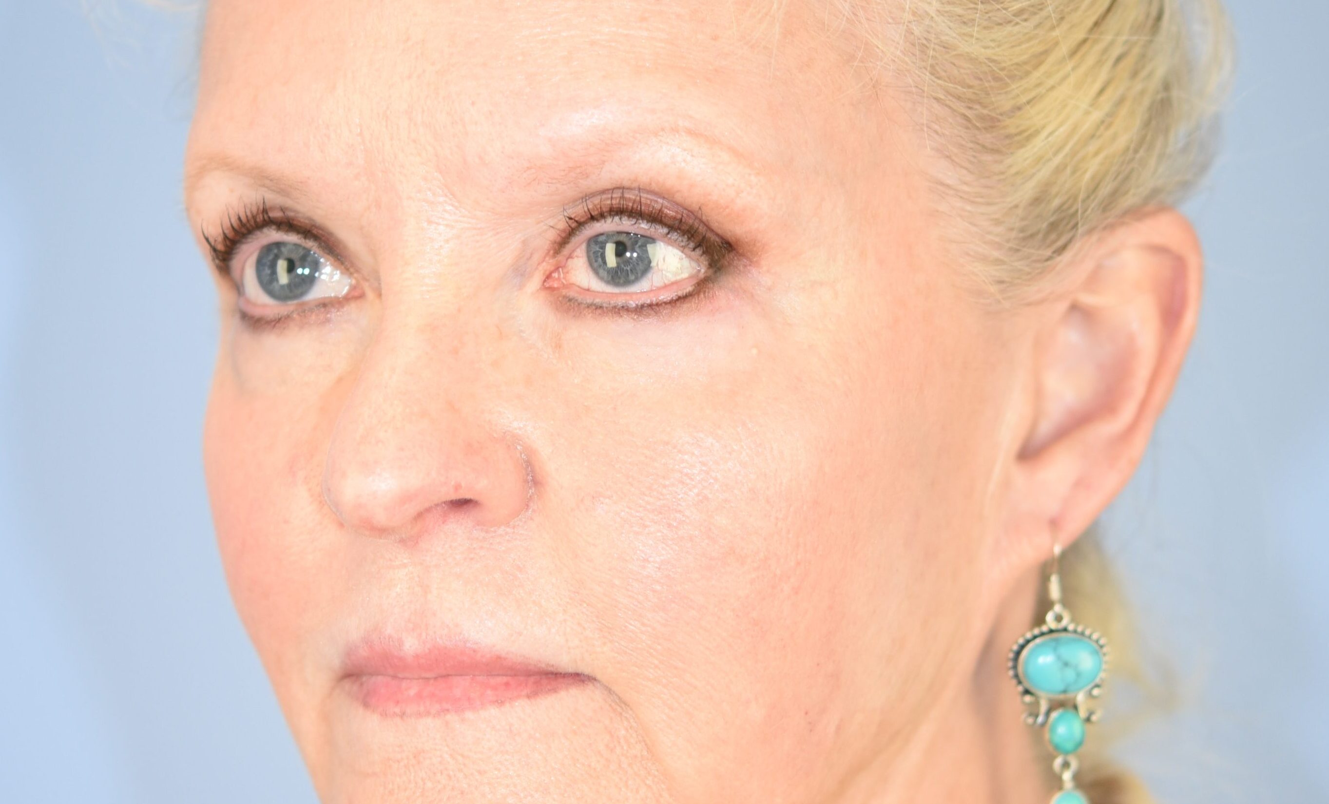 preop-20180409(6) copy