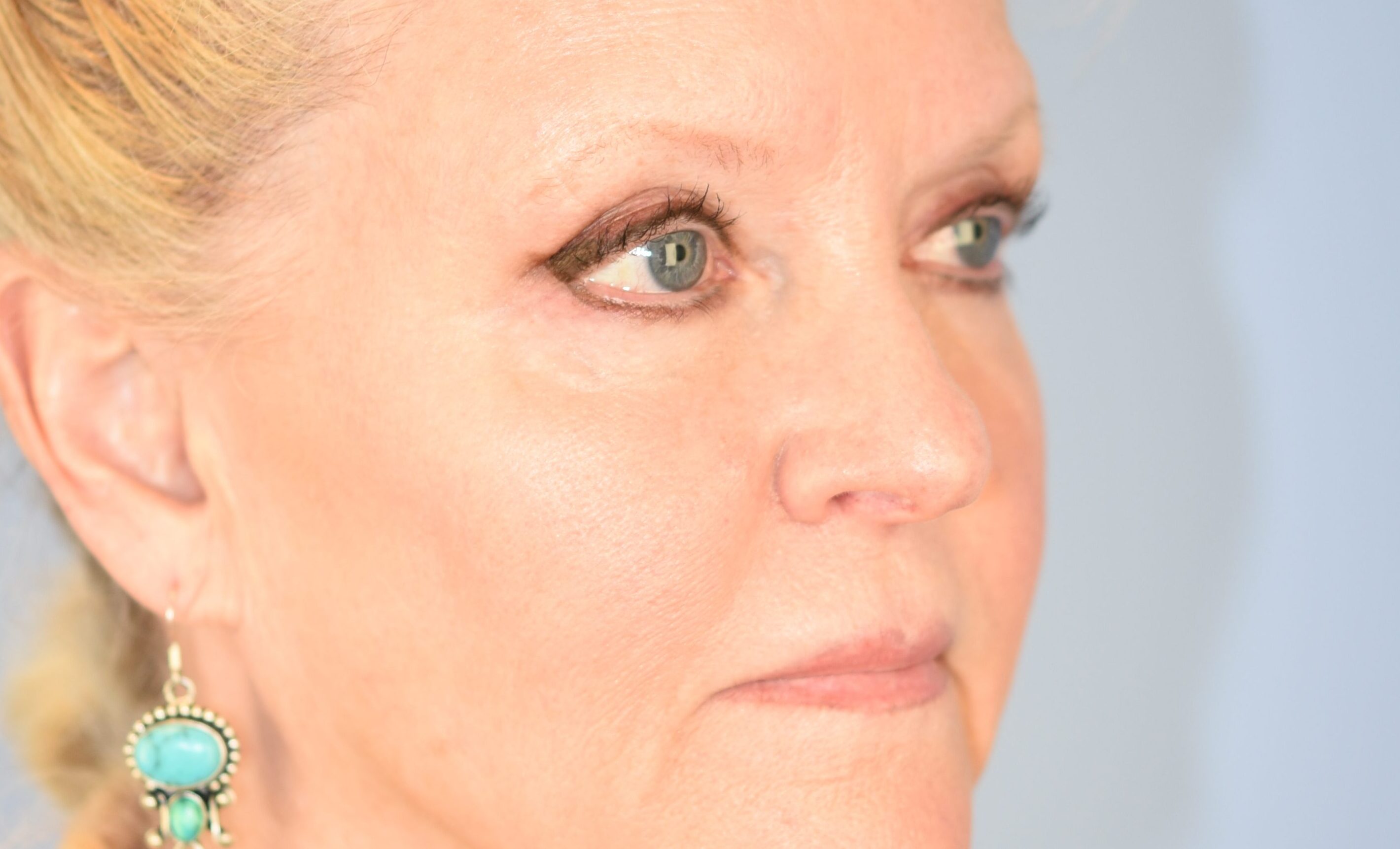 preop-20180409(8) copy